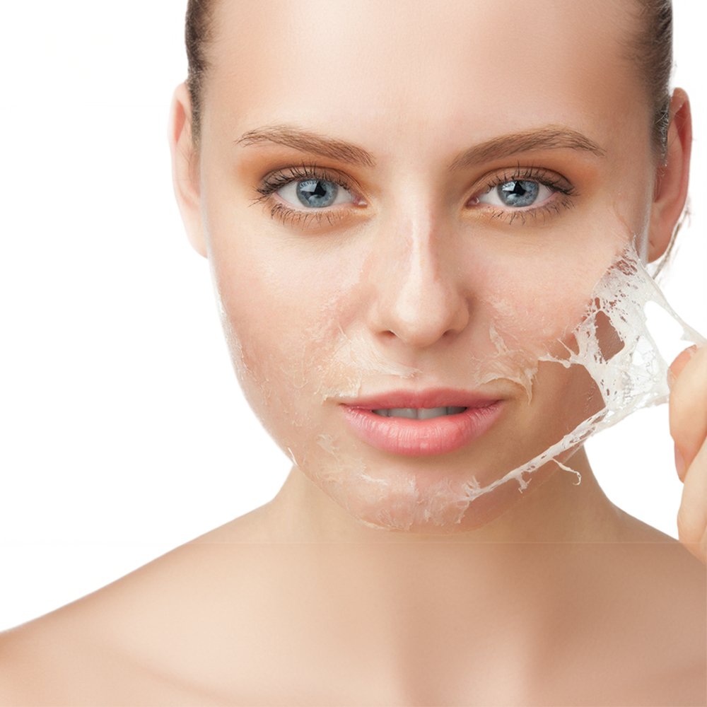 Kimyasal Peeling